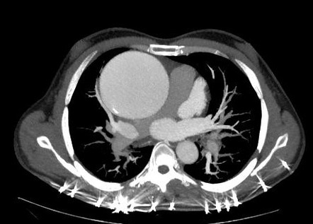 Ascending Aortic Aneurysm 