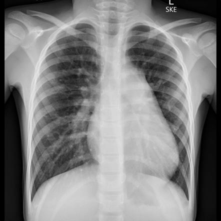 Atrial septal defect | Radiology Case | Radiopaedia.org