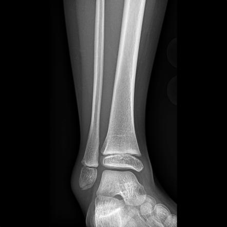 Fibular Avulsion Fracture