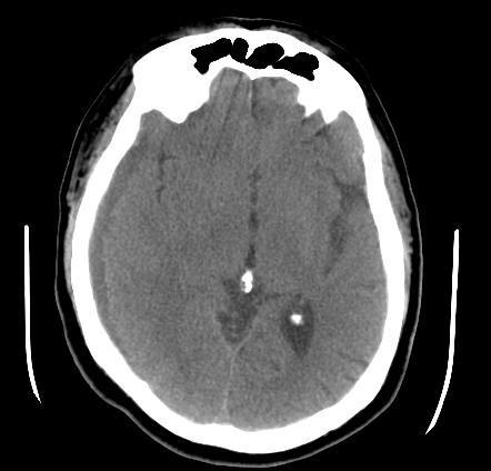 Subdural Hematoma Image Radiopaedia Org