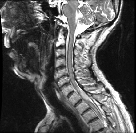 Superficial siderosis | Radiology Reference Article | Radiopaedia.org