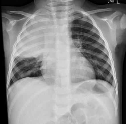 Horizontal fissure | Radiology Reference Article | Radiopaedia.org