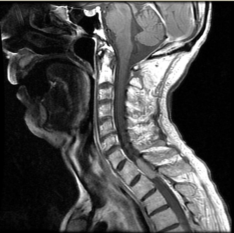 Superficial siderosis | Image | Radiopaedia.org