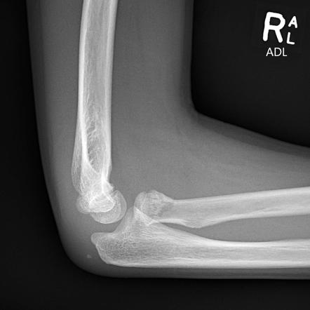 Viewing playlist: Paed Elbow Trauma (pre) | Radiopaedia.org