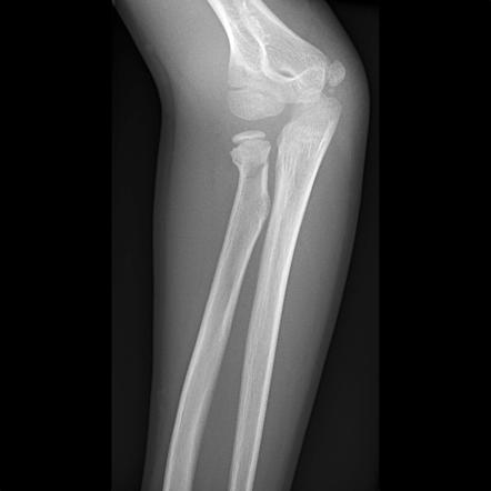 Radial neck and olecranon fractures | Image | Radiopaedia.org