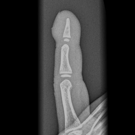 Finger clubbing | Radiology Reference Article | Radiopaedia.org