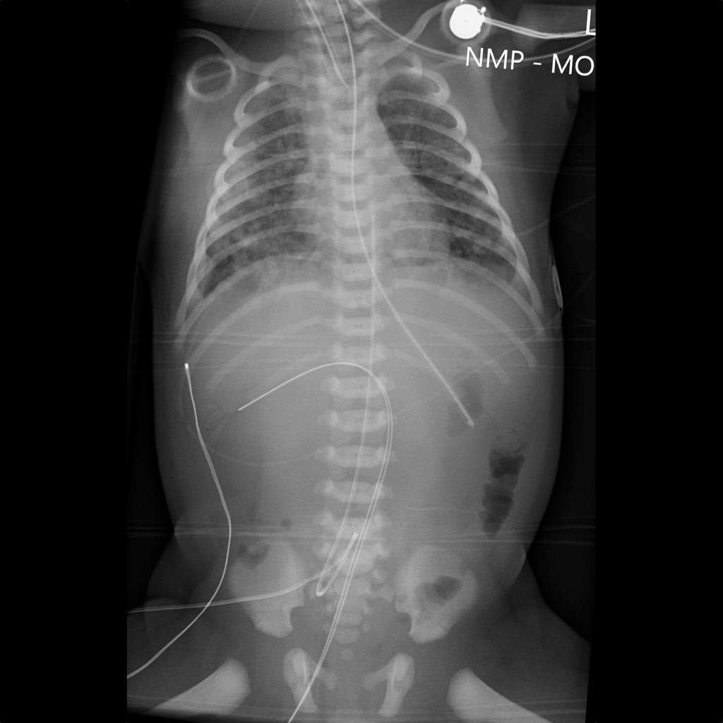 Uvc In Right Portal Vein Radiology Case Radiopaedia Org