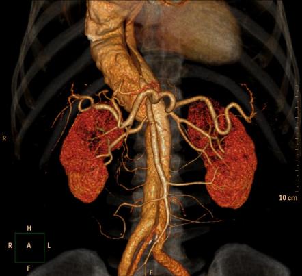 Aortic dissection | Radiology Reference Article | Radiopaedia.org