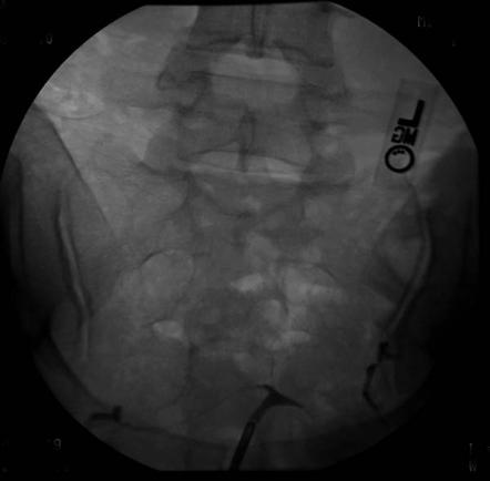 T Shaped Uterus Radiology Case Radiopaedia Org   7c2ca1bf53c01e964f48af3689a0c3 Gallery 