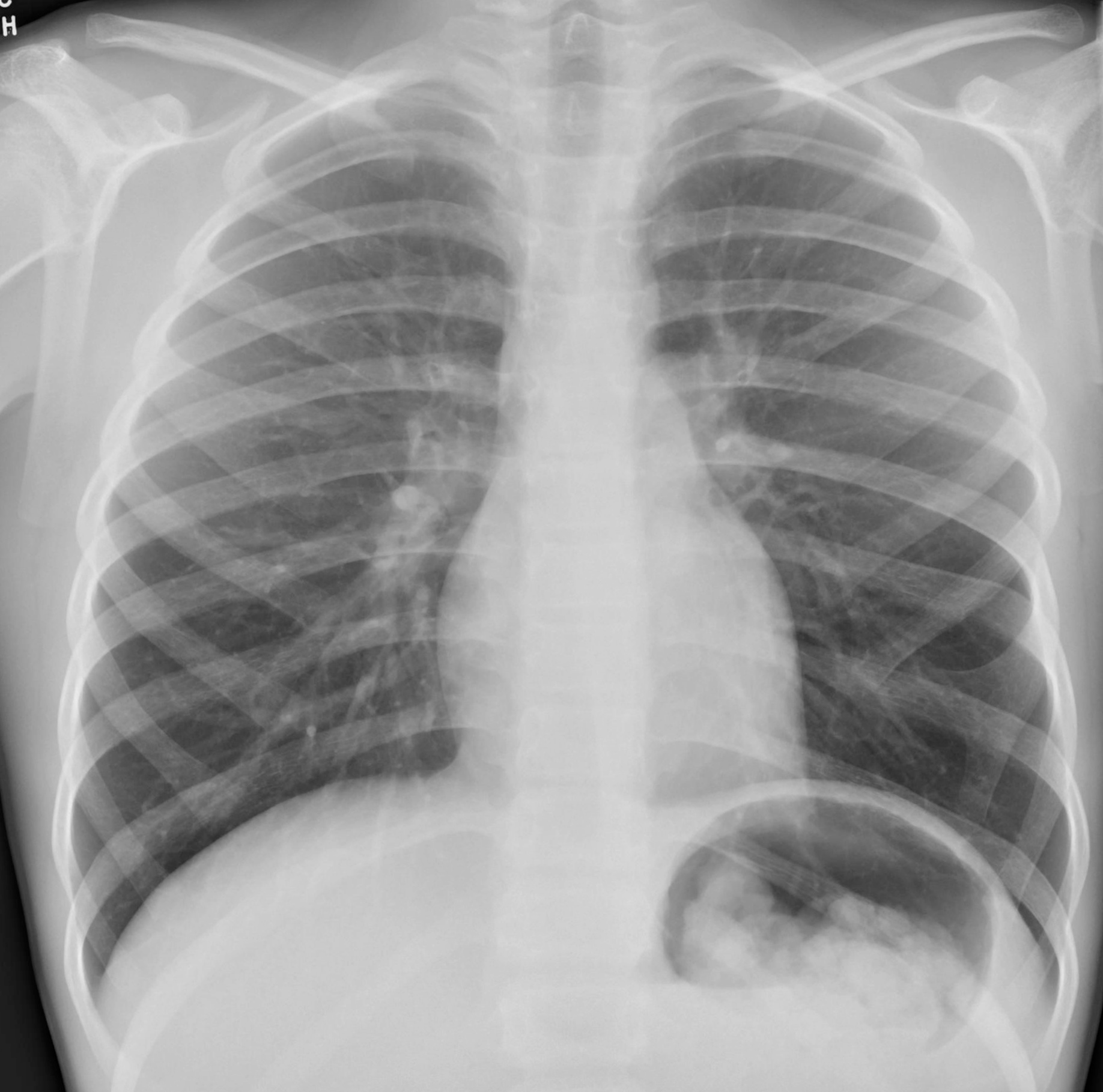 Bifid ribs | Image | Radiopaedia.org