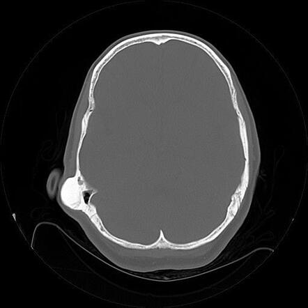 Skull vault osteoma | Radiology Reference Article | Radiopaedia.org