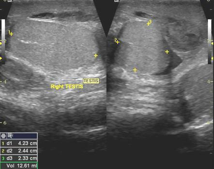 Scrotal hematocele | Radiology Reference Article | Radiopaedia.org