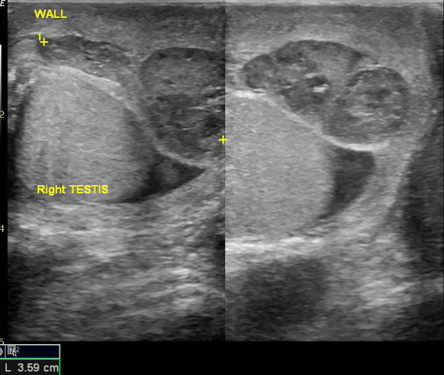 Scrotal wall hematoma | Image | Radiopaedia.org