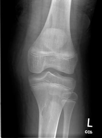 Tibial Tuberosity Avulsion Fracture 