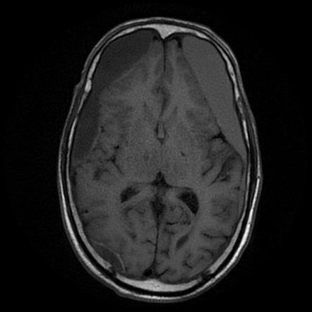 Bilateral sub-acute subdural hematomas | Image | Radiopaedia.org