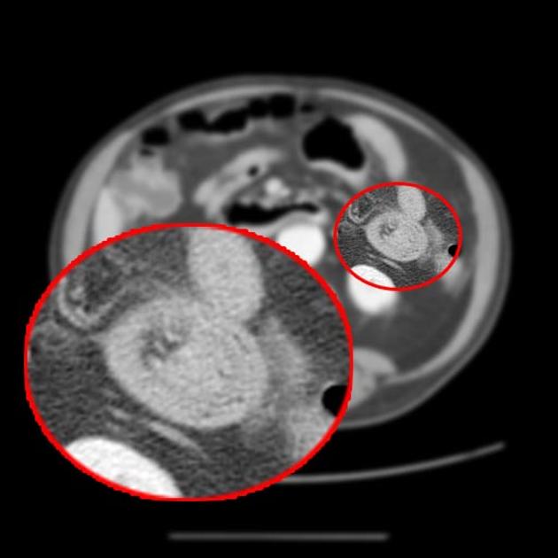 intussusception