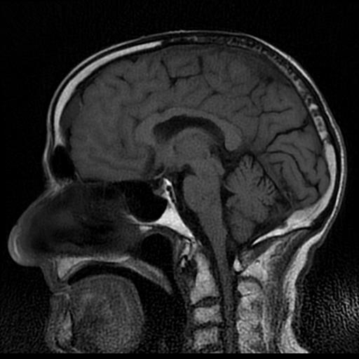 Bilateral sub-acute subdural hematomas | Image | Radiopaedia.org