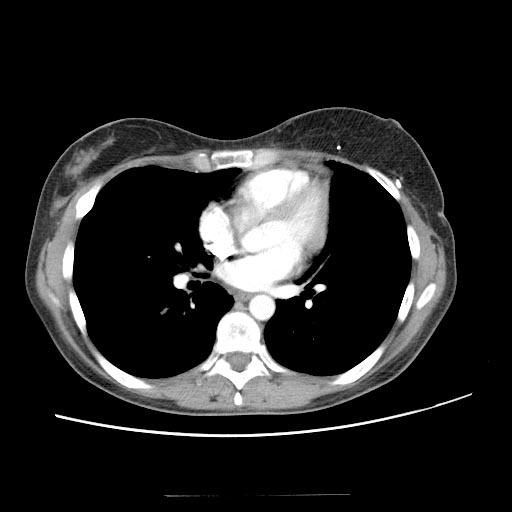 Transverse rectus abdominis musculocutaneous flap | Image | Radiopaedia.org