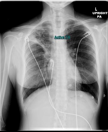 Tuberculosis | Radiology Case | Radiopaedia.org