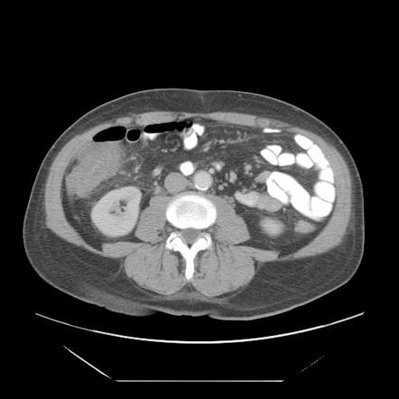 Typhlitis | Radiology Reference Article | Radiopaedia.org