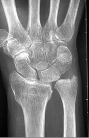 Positive ulnar variance | Radiology Reference Article | Radiopaedia.org