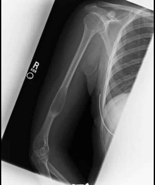 Unicameral bone cyst | Image | Radiopaedia.org