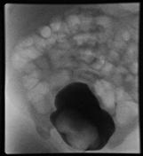 vcug procedure