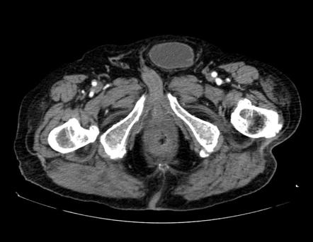 Urinary bladder hernia | Radiology Case | Radiopaedia.org