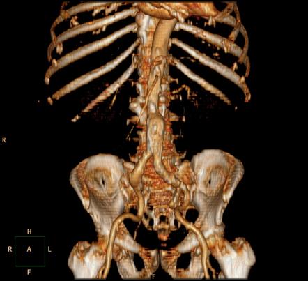 Ct Stair-step Artifact 