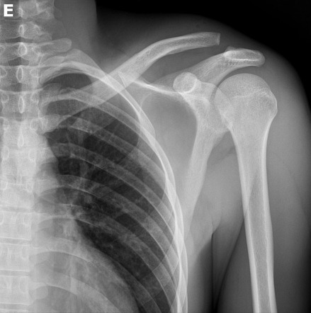 Acromioclavicular joint injury - Rockwood type III | Radiology Case ...