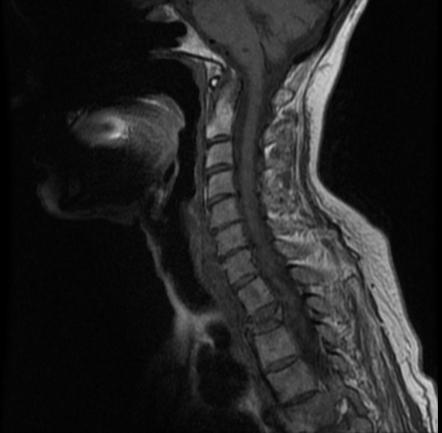 Vertebra Plana 