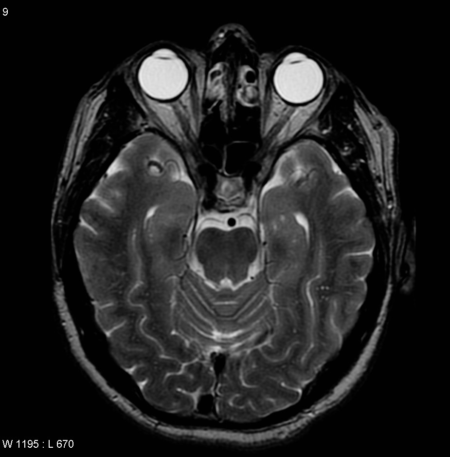 6th Cranial Nerve Mri 4654