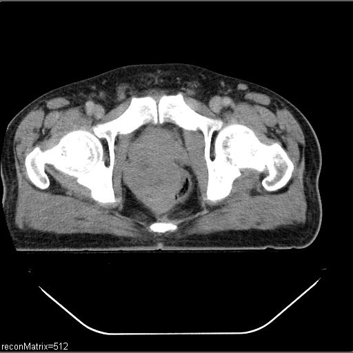 Prostatic adenocarcinoma with metastases | Image | Radiopaedia.org