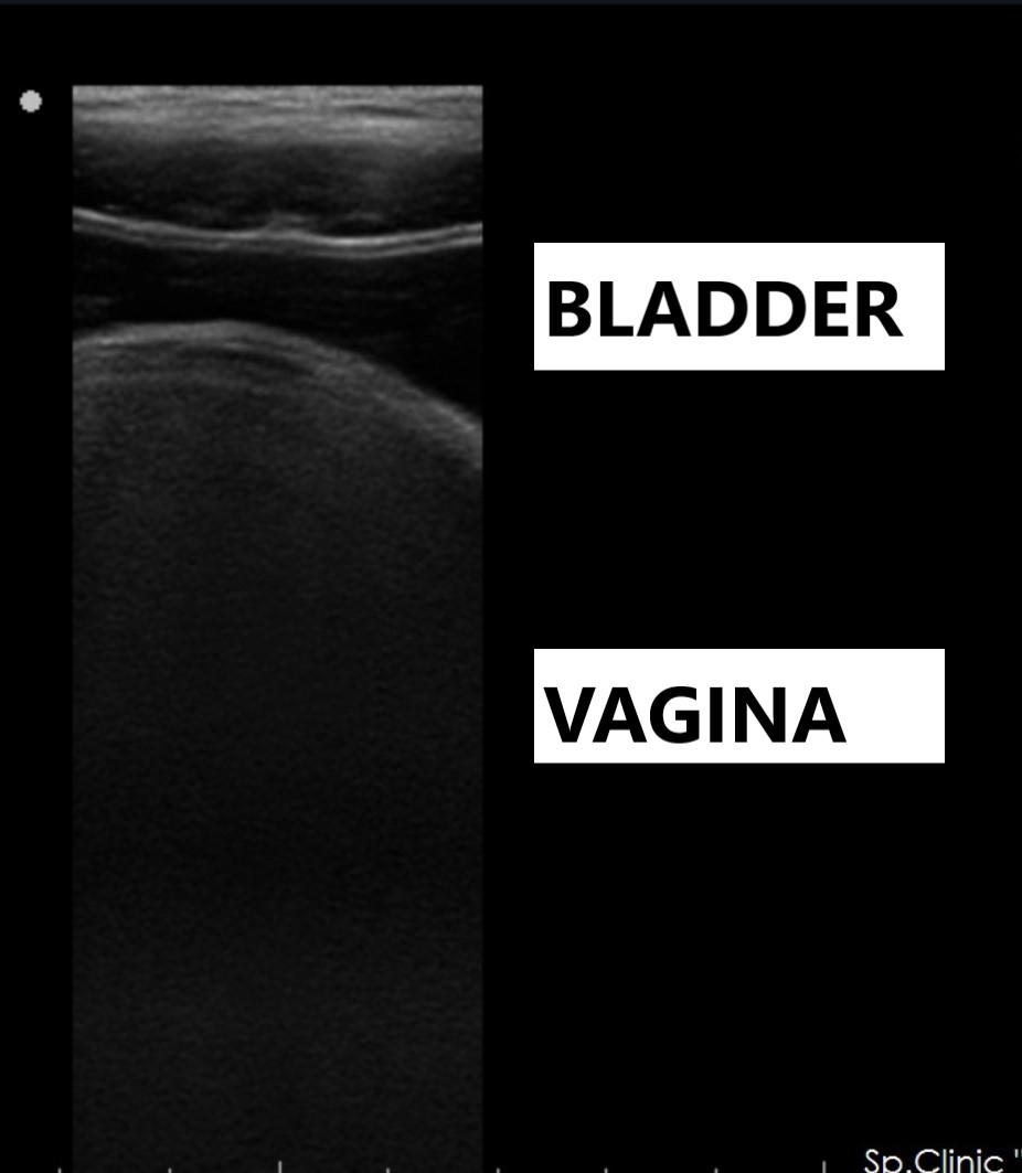 Hematocolpos Image Radiopaedia Org