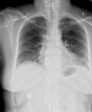 Intra-abdominal calcification | Radiology Reference Article ...