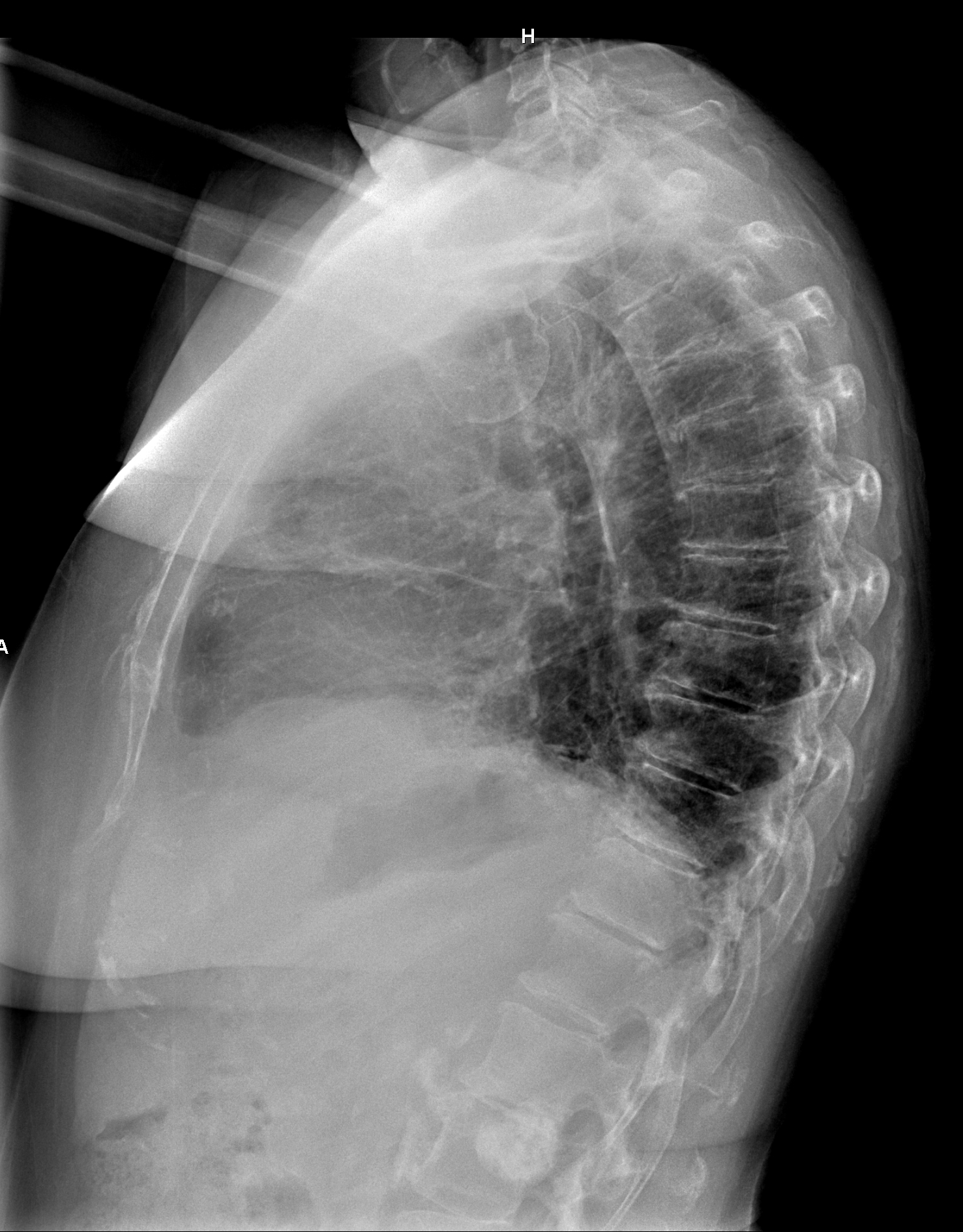 Calcified Renal Lesion Image