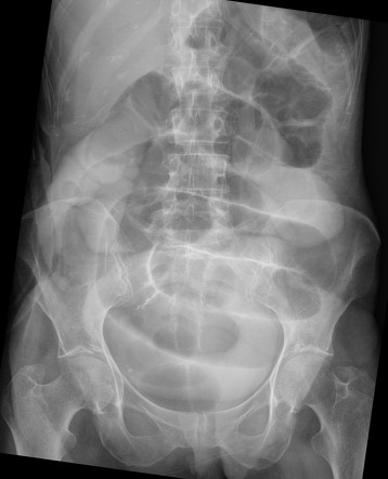 Distal ileal obstruction | Radiology Case | Radiopaedia.org