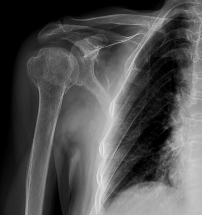 Neer classification of proximal humeral fractures | Radiology Reference ...