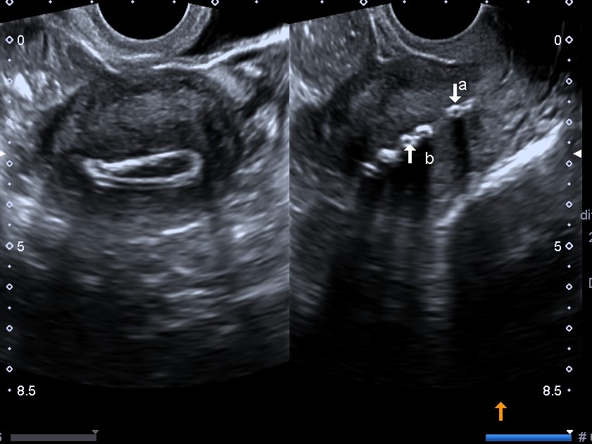 Lippes loop contraceptive device | Image | Radiopaedia.org