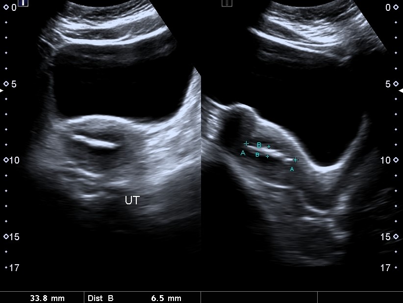 Lippes loop contraceptive device | Image | Radiopaedia.org