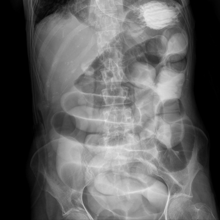 Distal ileal obstruction | Image | Radiopaedia.org