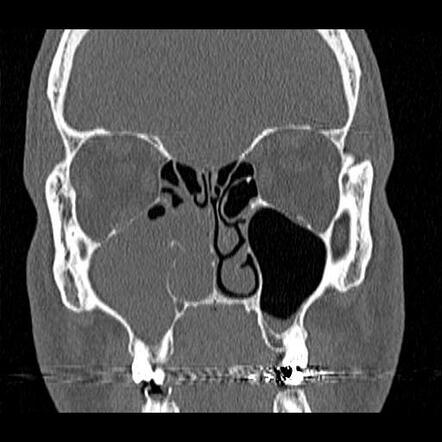 Antrochoanal polyp | Radiology Case | Radiopaedia.org