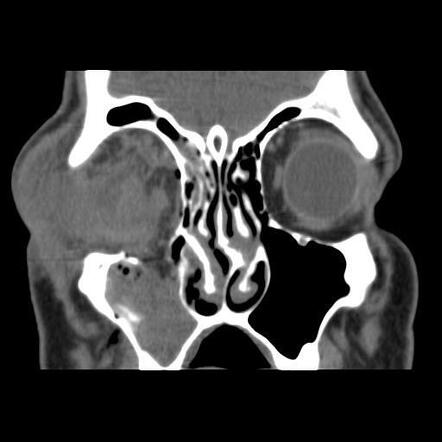 Ocular rupture and orbital blow-out fracture | Radiology Case ...