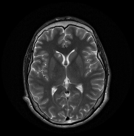 Caudate head cavernoma | Radiology Case | Radiopaedia.org