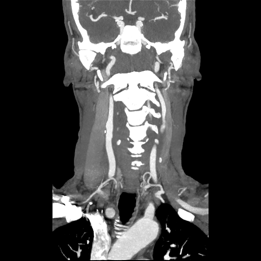 TIPIC syndrome | Image | Radiopaedia.org