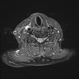 TIPIC syndrome | Image | Radiopaedia.org