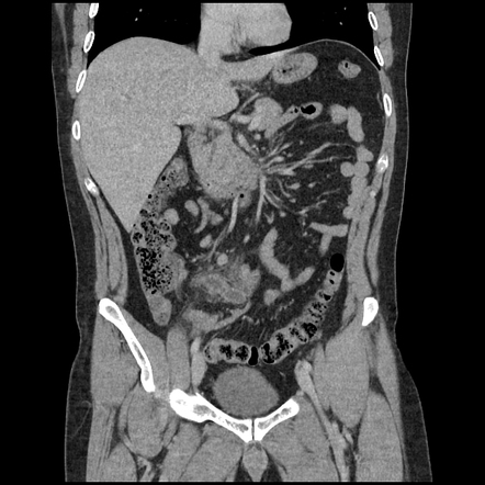 Acute appendicitis | Radiology Reference Article | Radiopaedia.org