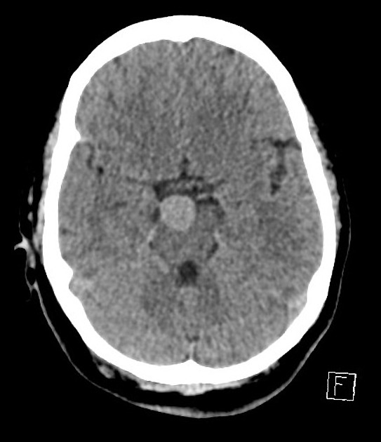 Basilar Artery Aneurysm