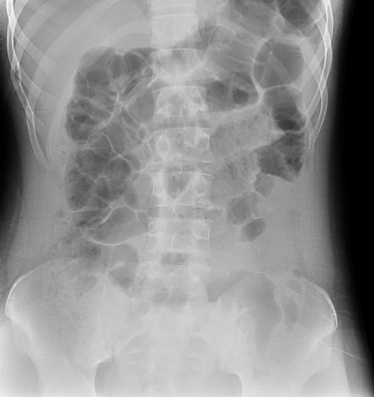 Pneumoperitoneum - Rigler sign | Radiology Case | Radiopaedia.org