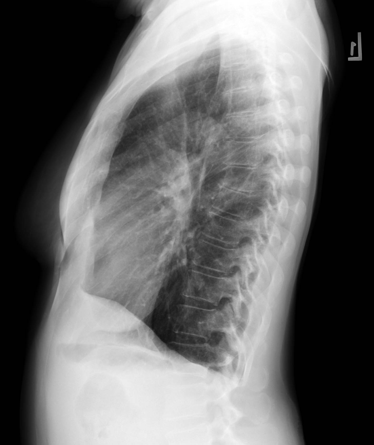 Situs inversus | Image | Radiopaedia.org